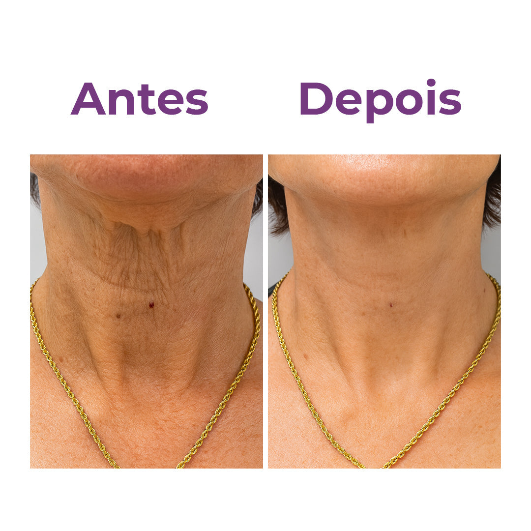 NeckLux - Adesivo para rugas e flacidez do pescoço