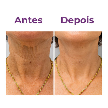 NeckLux - Adesivo para rugas e flacidez do pescoço